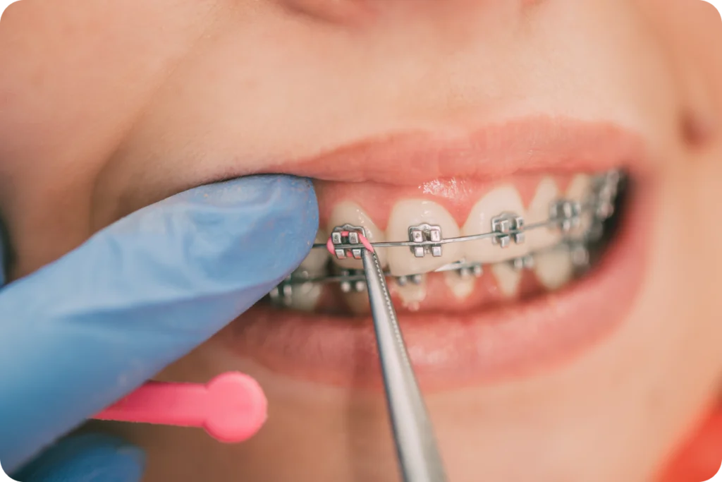 Les incidents en orthodontie